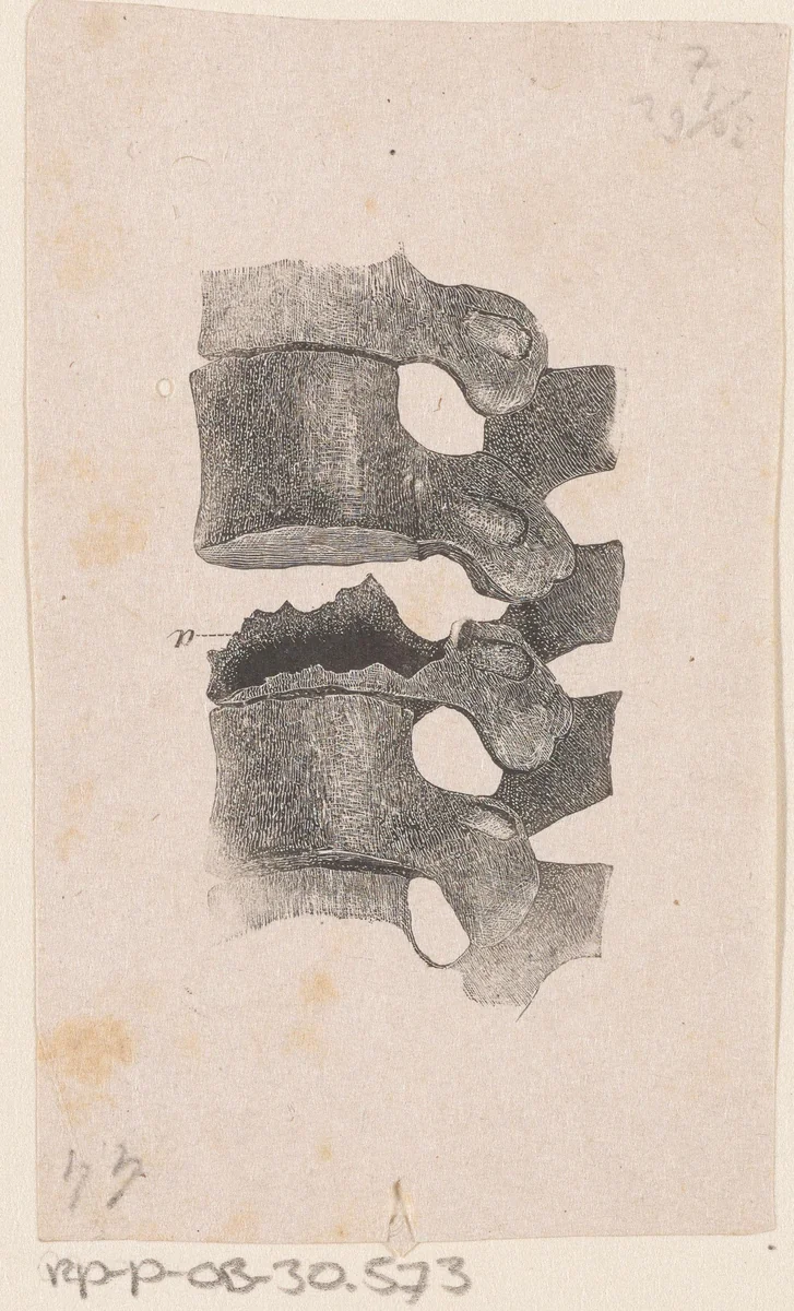 Menselijke wervelkolom met een afwijking by Isaac Weissenbruch, print, 1836-1912
