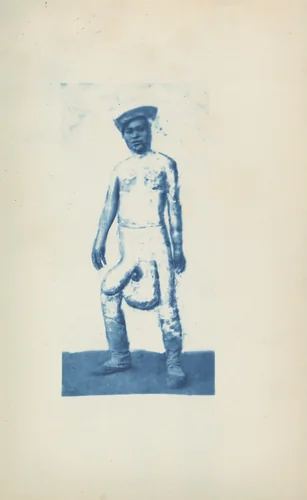 Elephantiasis by Unknown 19th Century, photograph, 1870-1879