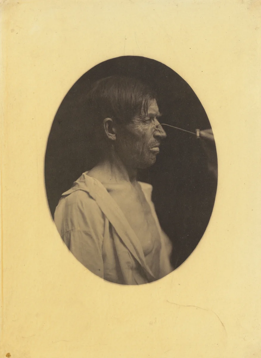 Bad humor, malcontentment by Guillaume-Benjamin-Amant Duchenne, photograph, 1854-1856