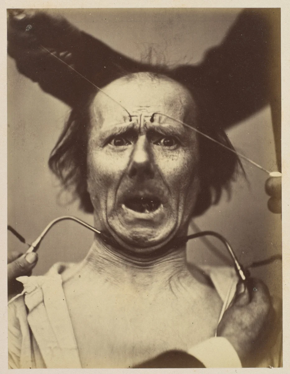 Icono-photographique. Mécanisme de la Physionomie Humaine. Fig. 65 by Guillaume Benjamin Amand Duchenne de Boulogne, photograph, 1854-1856
