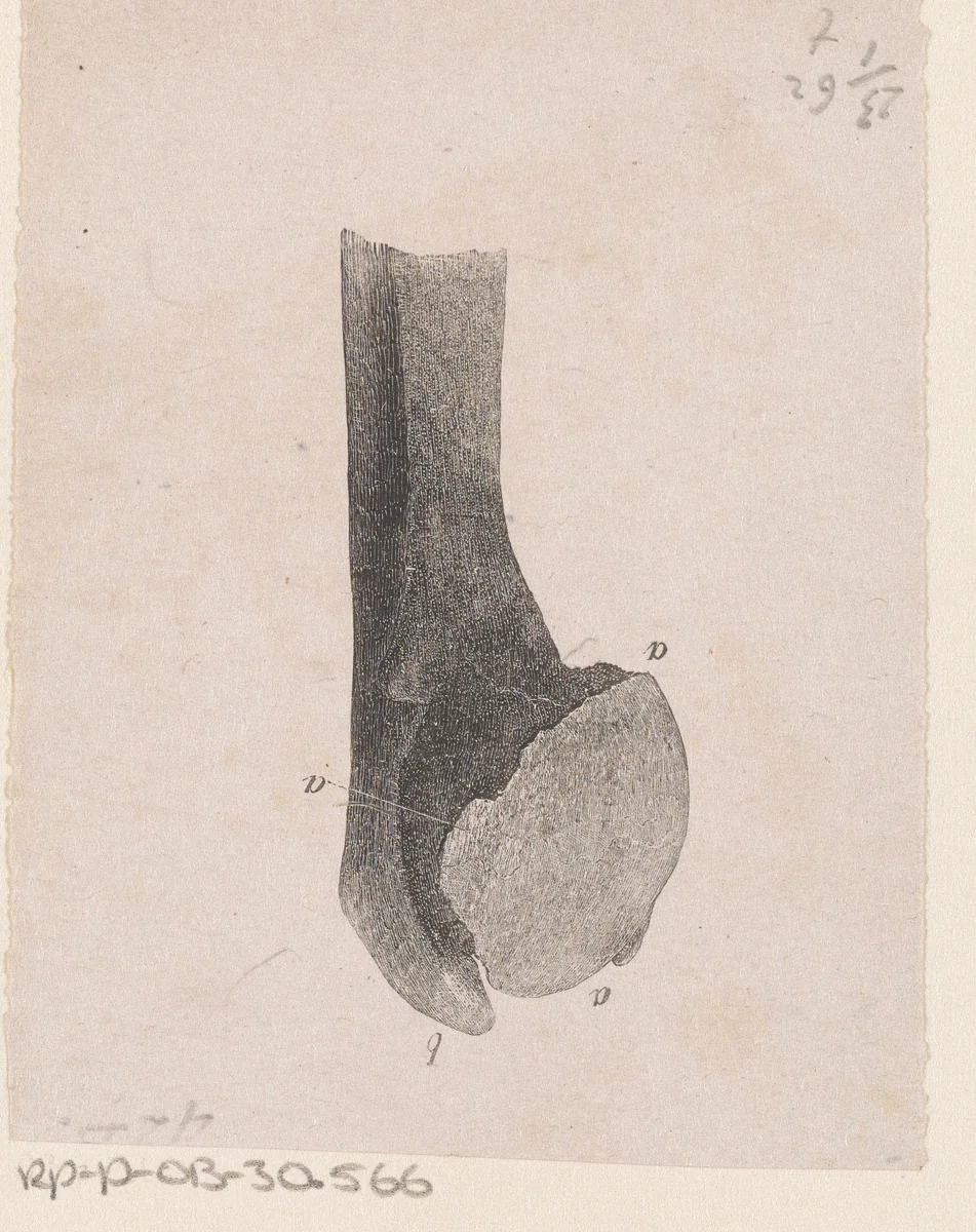 Menselijk bot met een afwijking by Isaac Weissenbruch, print, 1836-1912