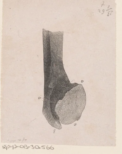 Menselijk bot met een afwijking by Isaac Weissenbruch, print, 1836-1912