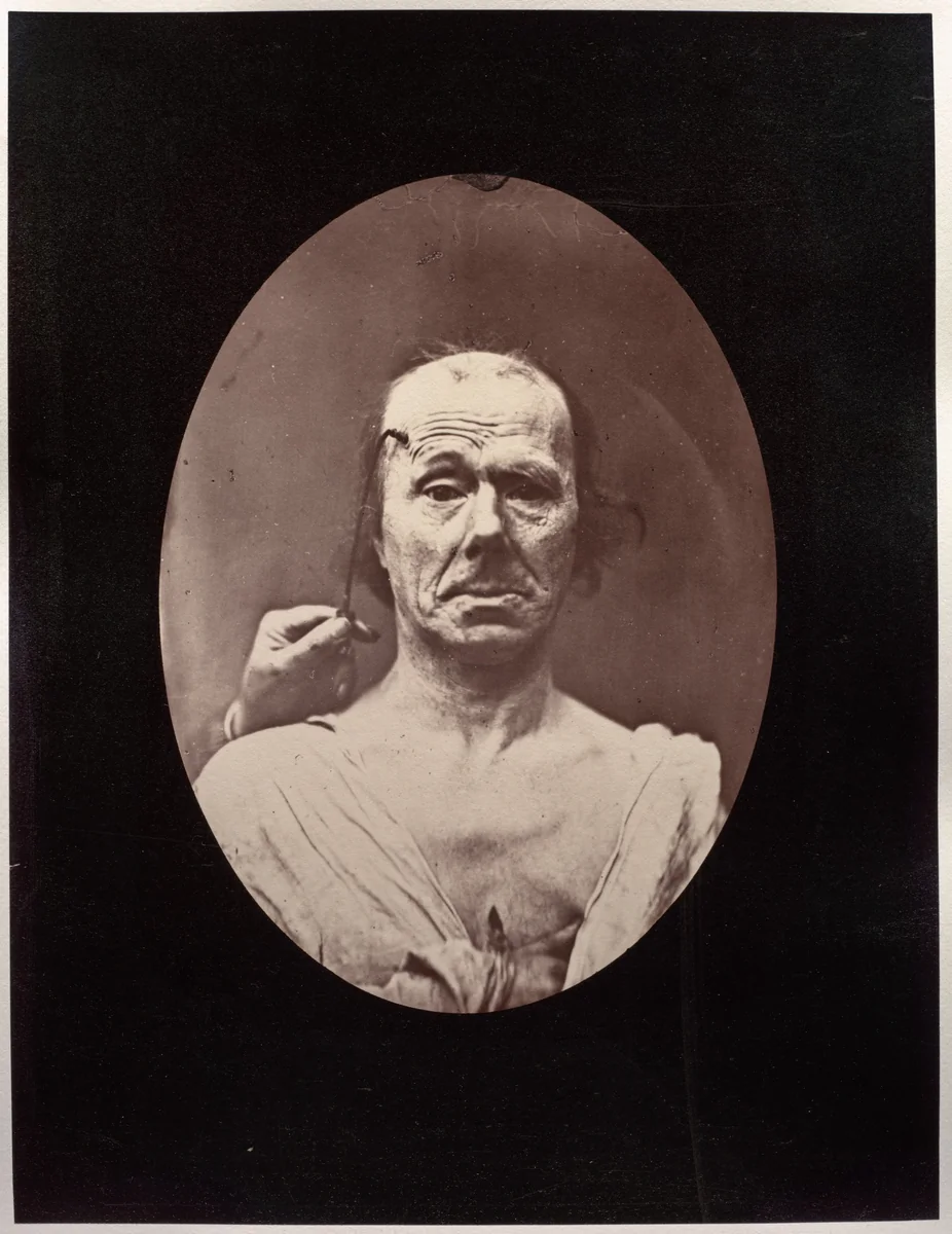 Figure 7: Étude du méchanisme et de l'expression du muscle frontal chez un vieillard: à droit, attention; à gauche, repos by Guillaume-Benjamin-Amand Duchenne, photograph, 1851-1861