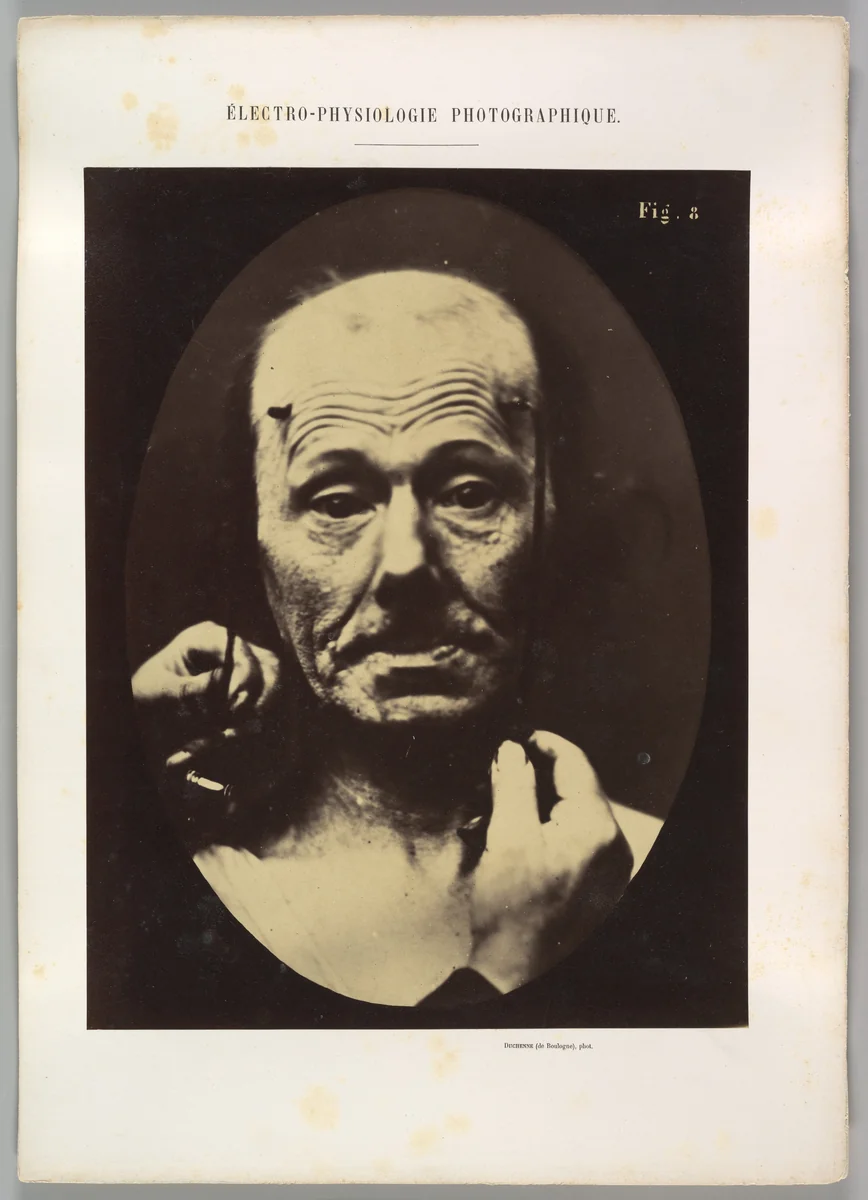 Figure 8: Contraction of the right m. frontalis. by Guillaume Benjamin Amand Duchenne de Boulogne, photograph, 1854-1856