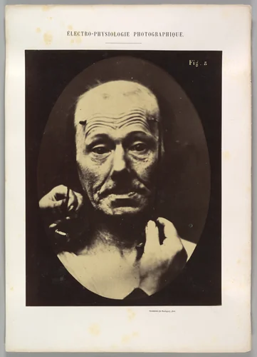 Figure 8: Contraction of the right m. frontalis. by Guillaume Benjamin Amand Duchenne de Boulogne, photograph, 1854-1856