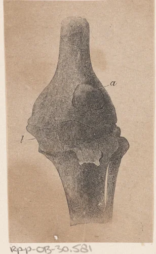 Menselijk bot met een afwijking by Isaac Weissenbruch, print, 1836-1912