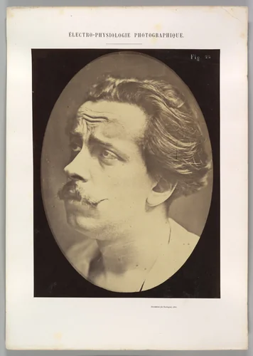 Figure 25: Not an expression of pain by Guillaume Benjamin Amand Duchenne de Boulogne, photograph, 1854-1856