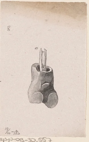 Onderdeel van het menselijk lichaam met een afwijking by Isaac Weissenbruch, print, 1836-1912