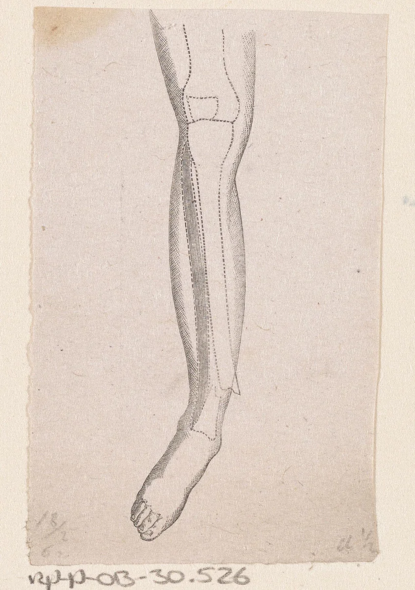 Menselijk onderbeen met een breuk in het bot by Isaac Weissenbruch, print, 1836-1912