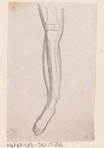 Menselijk onderbeen met een breuk in het bot by Isaac Weissenbruch, print, 1836-1912