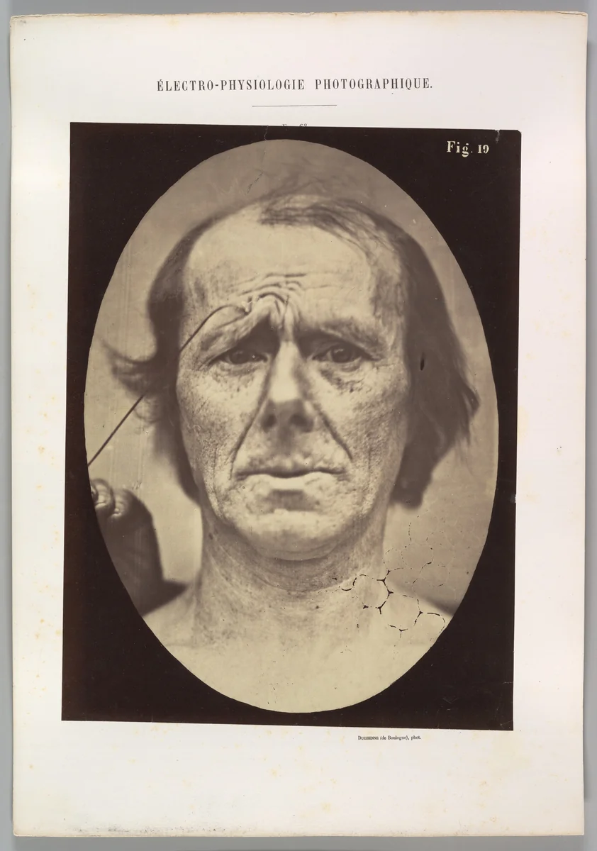 Figure 19: Suffering by Guillaume Benjamin Amand Duchenne de Boulogne, photograph, 1854-1856
