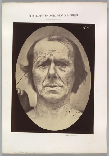 Figure 19: Suffering by Guillaume Benjamin Amand Duchenne de Boulogne, photograph, 1854-1856