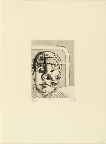 Skin Graft (Transplantation) from The War (Der Krieg) by Otto Dix, print, 1924