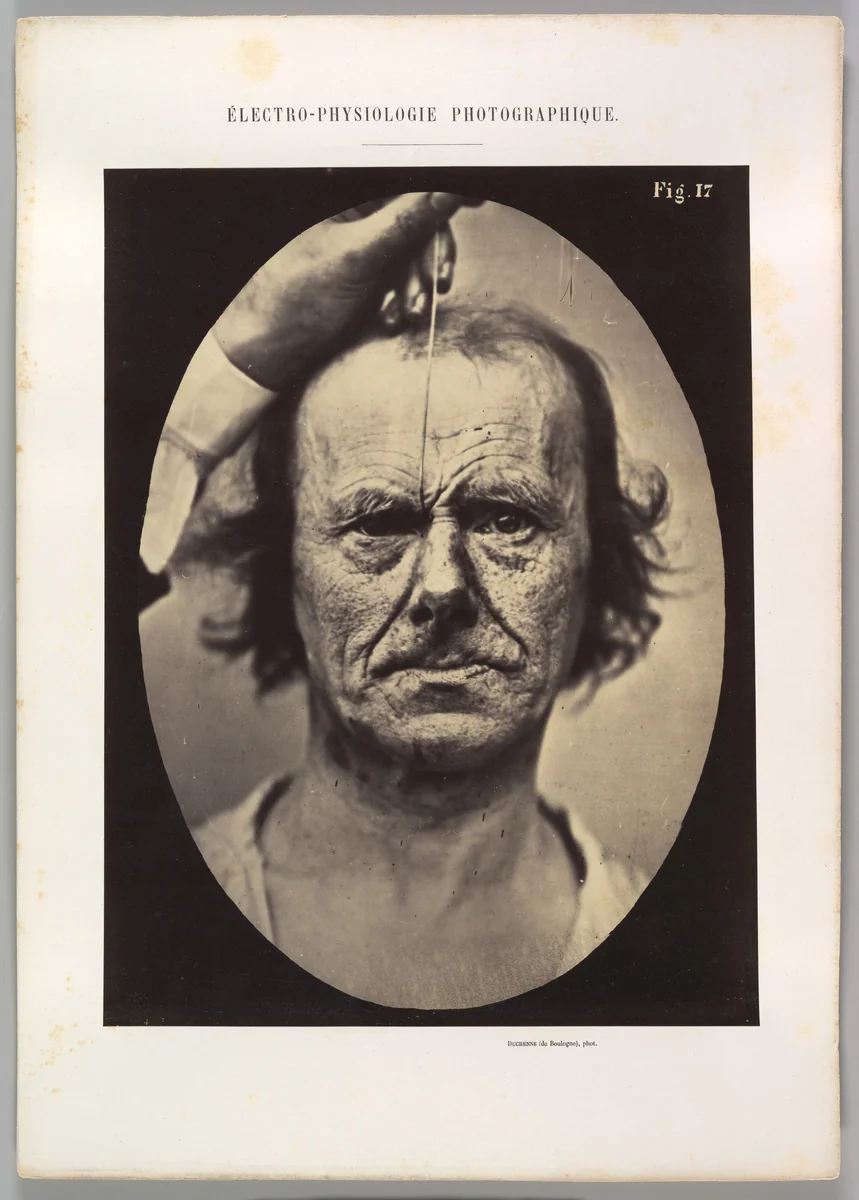 Figure 17: On the right, electrization of m. procerus: severity, aggression. On the left: attention. by Guillaume Benjamin Amand Duchenne de Boulogne, photograph, 1854-1856