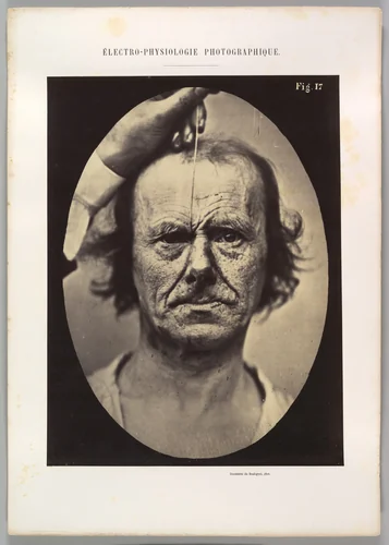 Figure 17: On the right, electrization of m. procerus: severity, aggression. On the left: attention. by Guillaume Benjamin Amand Duchenne de Boulogne, photograph, 1854-1856