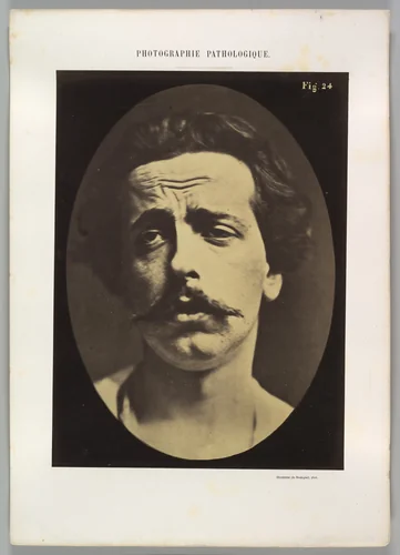Figure 24: Extreme pain to the point of exhaustion, the head of Christ and memory of love or ecstatic gaze. by Guillaume Benjamin Amand Duchenne de Boulogne, photograph, 1854-1856