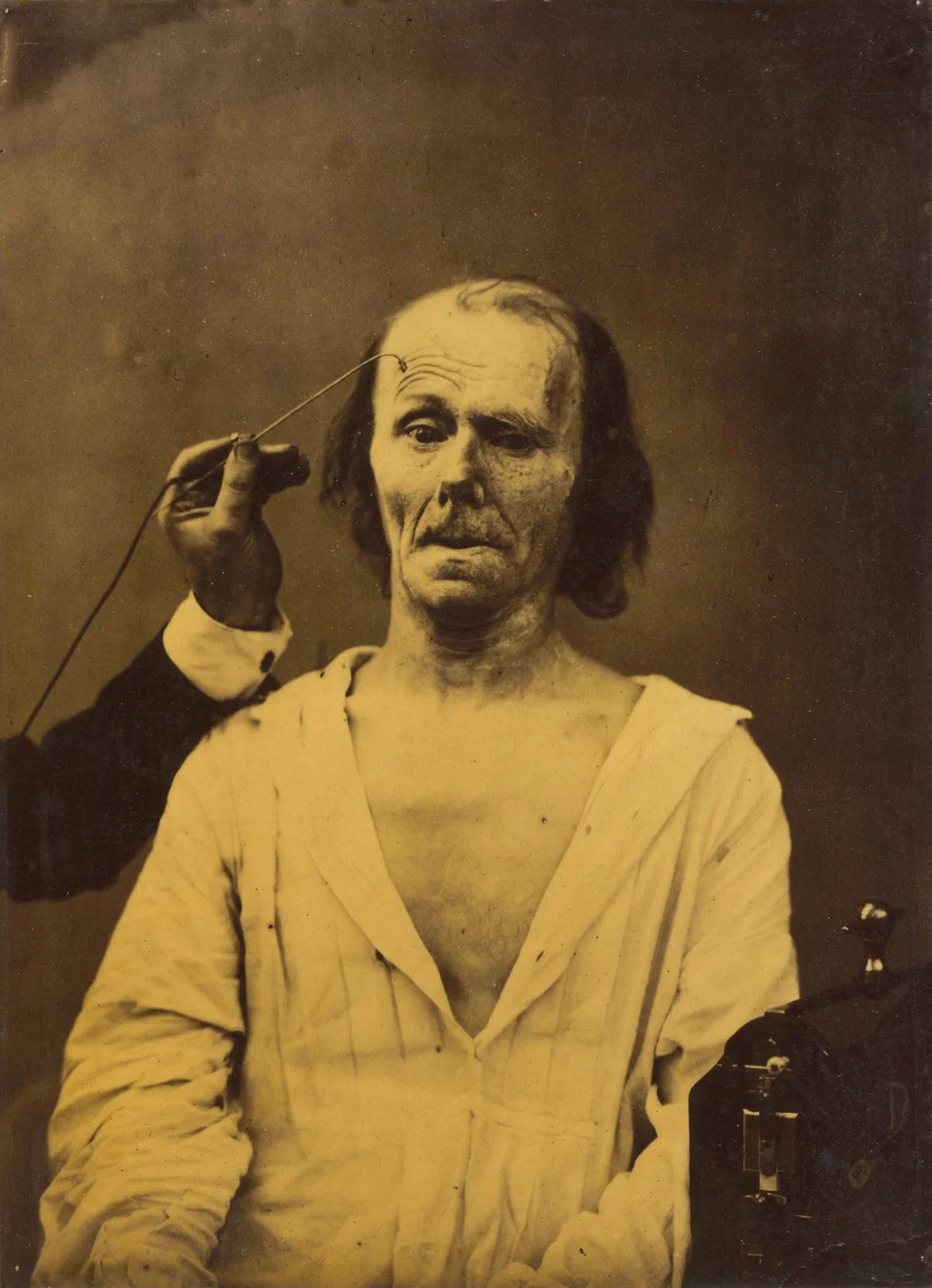 A relaxed face (left); Profound attention (right) by Guillaume-Benjamin-Amant Duchenne, photograph, 1854-1856