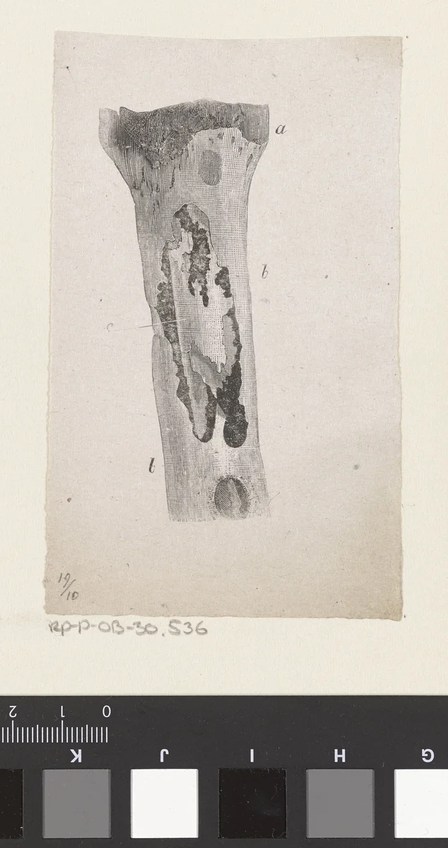 Menselijk bot met een afwijking by Isaac Weissenbruch, print, 1836-1912