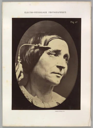 Figure 27: Expression proportionally more pained by Guillaume Benjamin Amand Duchenne de Boulogne, photograph, 1854-1856
