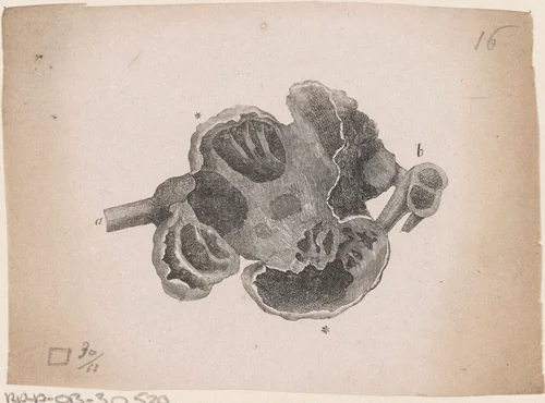 Onderdeel van het menselijk lichaam met een afwijking by Isaac Weissenbruch, print, 1836-1912