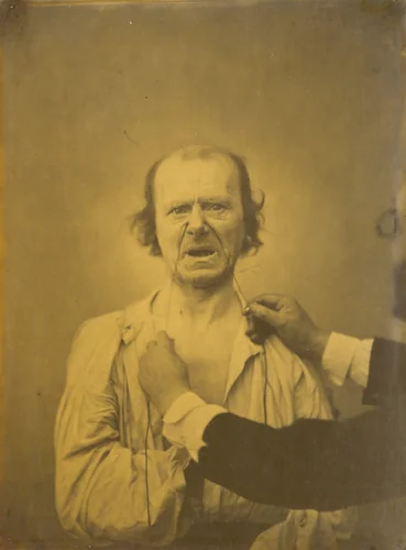 Discontent, bad humor by Guillaume-Benjamin-Amant Duchenne, photograph, 1854-1856