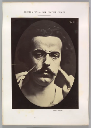 Figure 16: Expression of severity by Guillaume Benjamin Amand Duchenne de Boulogne, photograph, 1854-1856