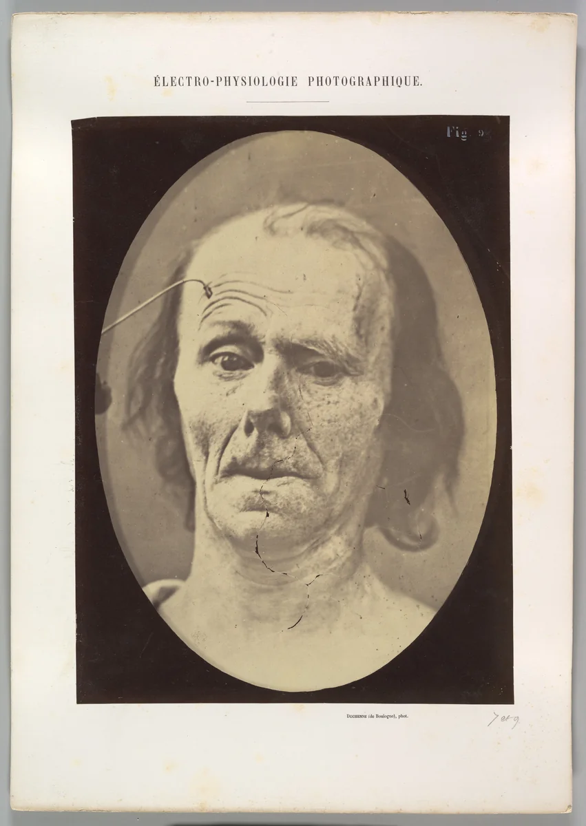 Figure 9: A study of m. frontalis in maximum contraction by Guillaume Benjamin Amand Duchenne de Boulogne, photograph, 1854-1856
