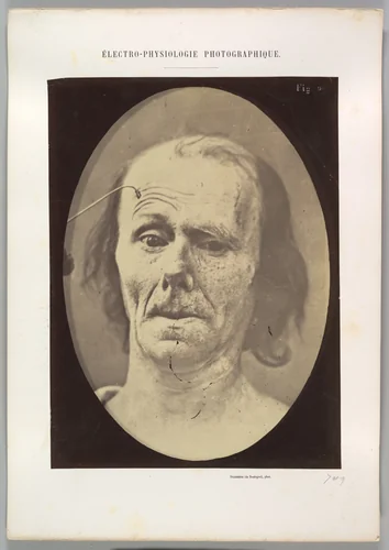 Figure 9: A study of m. frontalis in maximum contraction by Guillaume Benjamin Amand Duchenne de Boulogne, photograph, 1854-1856