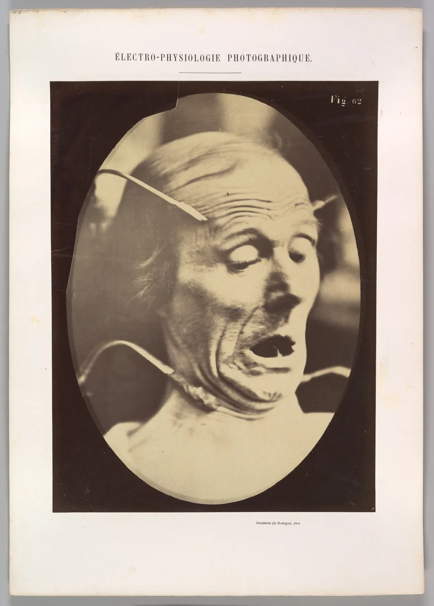 Figure 62: Terror, semiprofile by Guillaume Benjamin Amand Duchenne de Boulogne, photograph, 1854-1856