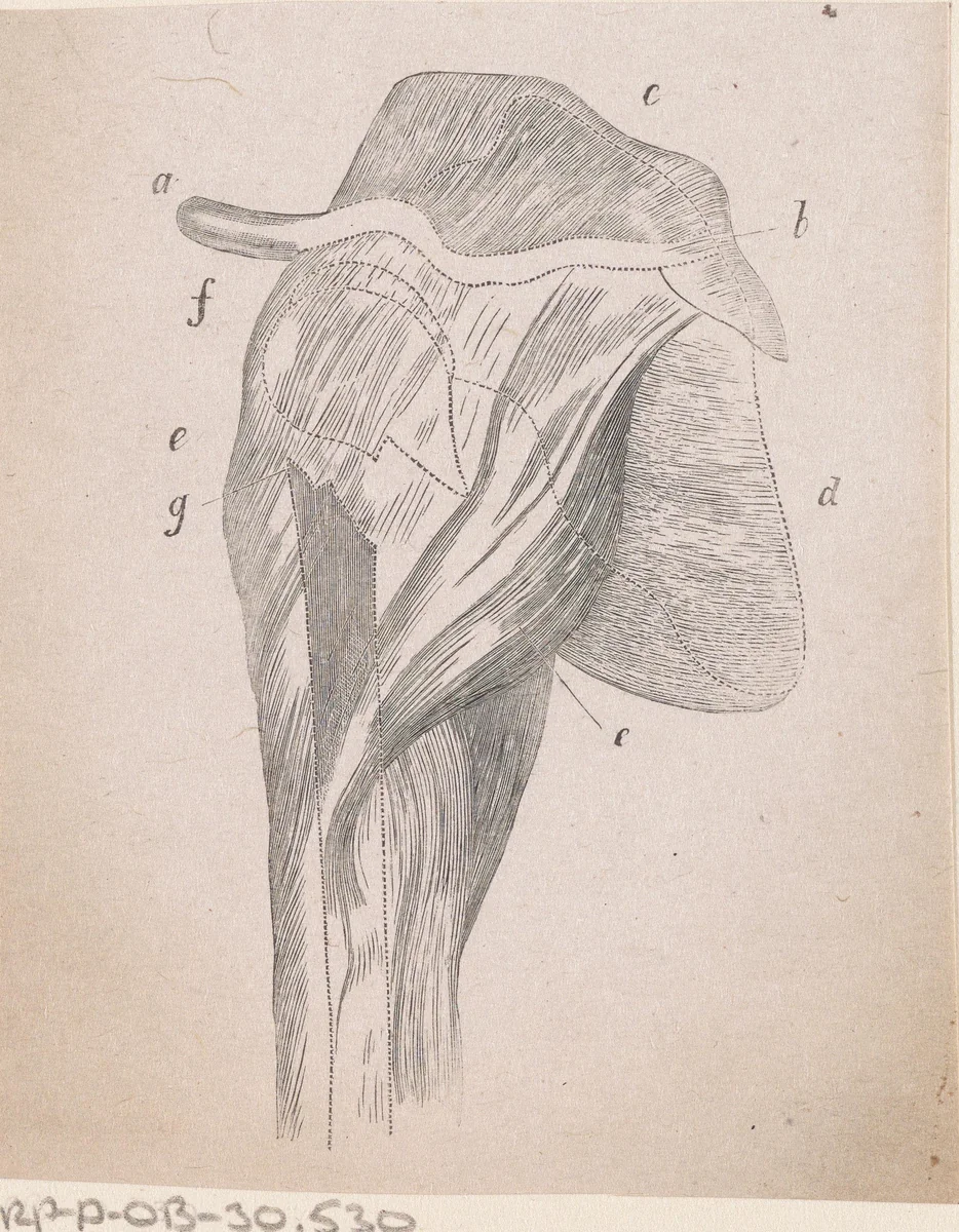 Onderdeel van het menselijk lichaam met een afwijking by Isaac Weissenbruch, print, 1836-1912