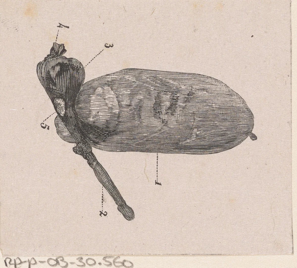 Onderdeel van het menselijk lichaam met een afwijking by Isaac Weissenbruch, print, 1836-1912
