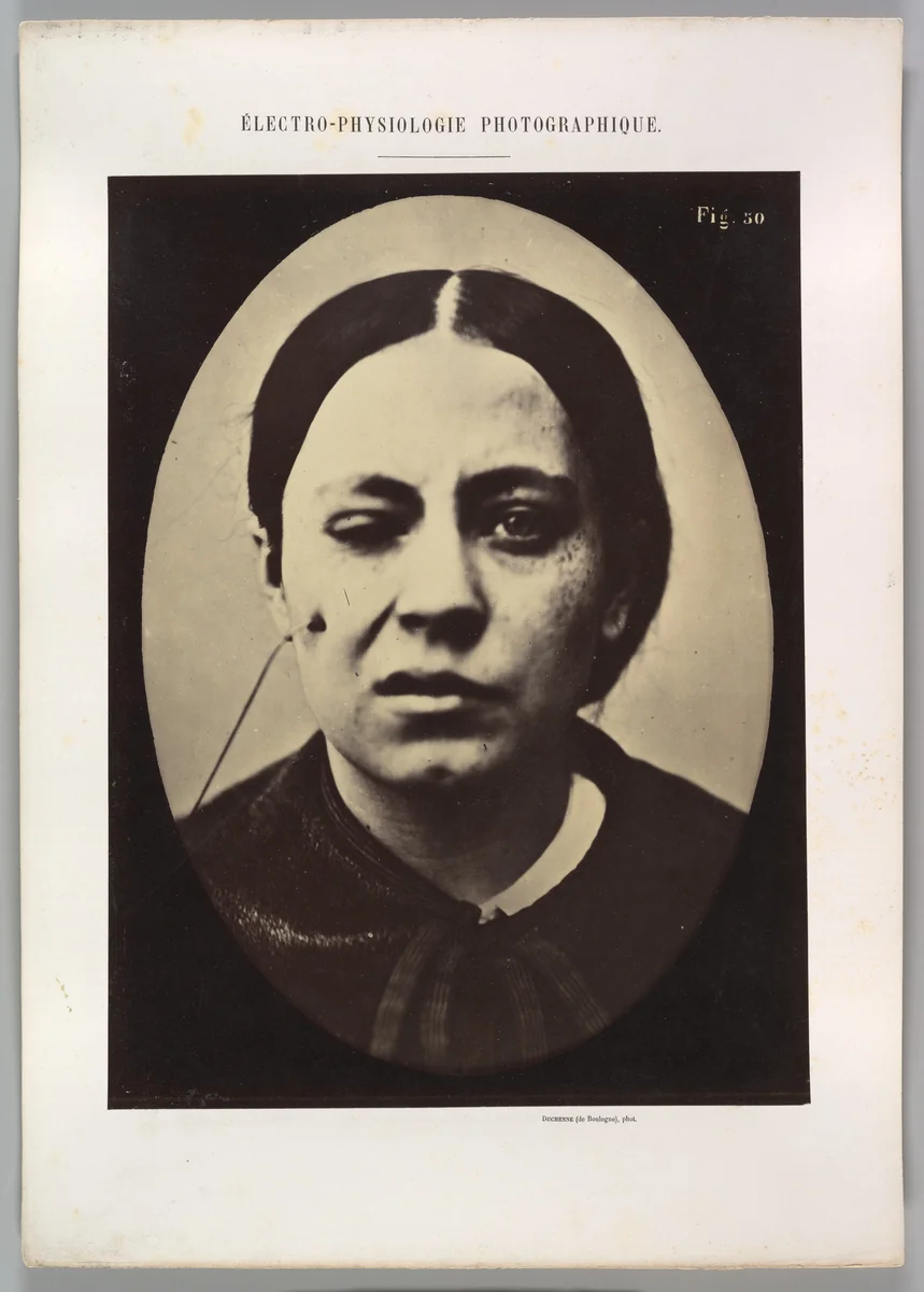 Figure 50: Affected weeping and face in repose by Guillaume Benjamin Amand Duchenne de Boulogne, photograph, 1854-1856