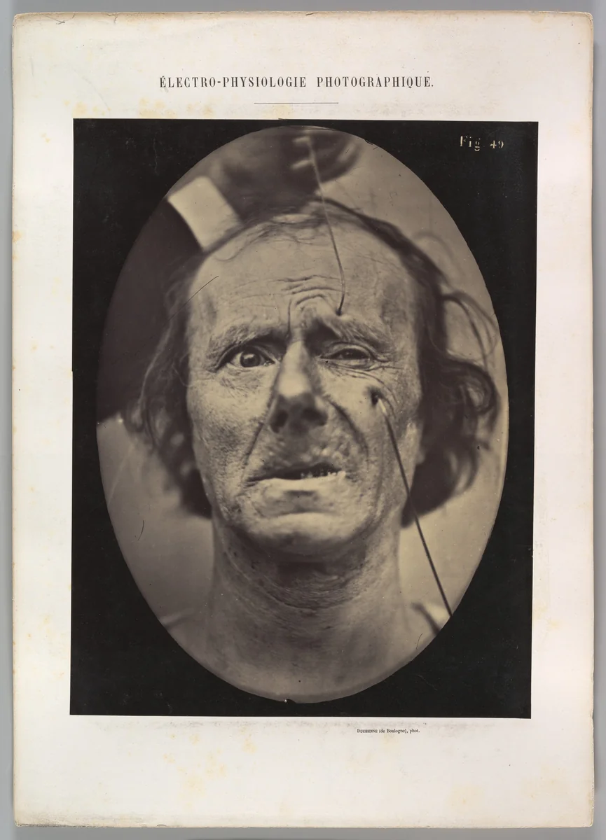 Figure 49: Painful weeping and forward looking. by Guillaume Benjamin Amand Duchenne de Boulogne, photograph, 1854-1856