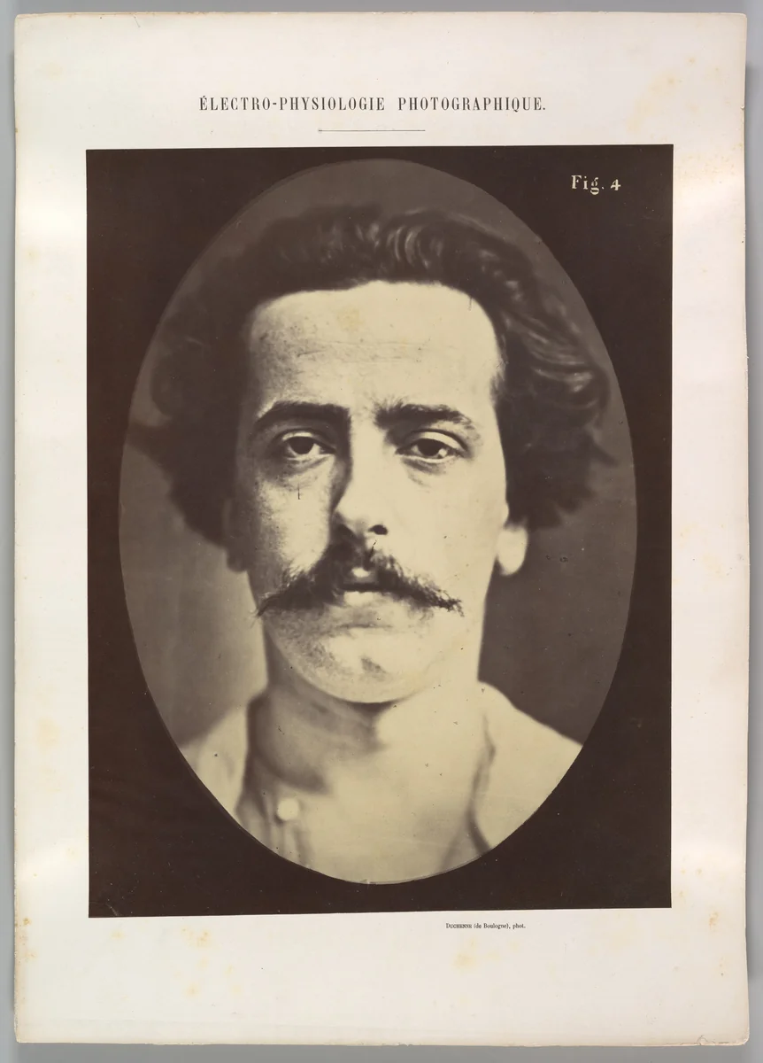 Figure 4: The face in repose of a young man by Guillaume Benjamin Amand Duchenne de Boulogne, photograph, 1854-1856