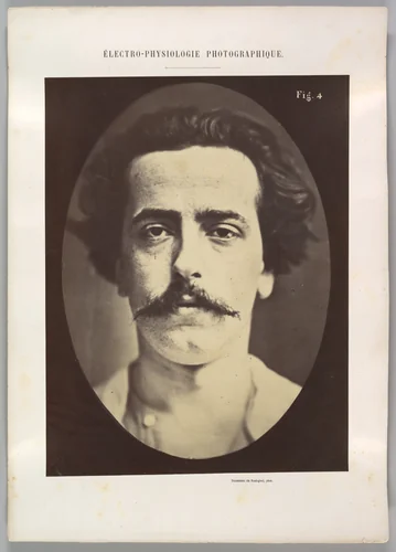 Figure 4: The face in repose of a young man by Guillaume Benjamin Amand Duchenne de Boulogne, photograph, 1854-1856