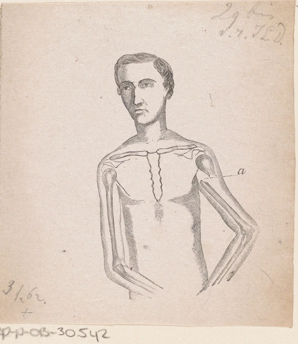 Man met een breuk in de linker bovenarm by Isaac Weissenbruch, print, 1836-1912