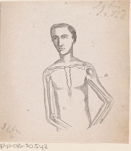 Man met een breuk in de linker bovenarm by Isaac Weissenbruch, print, 1836-1912
