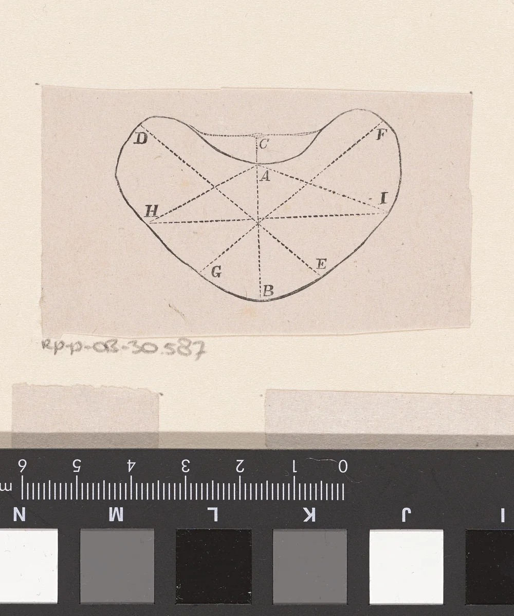 Onderdeel van het menselijk lichaam met een afwijking by Isaac Weissenbruch, print, 1836-1912
