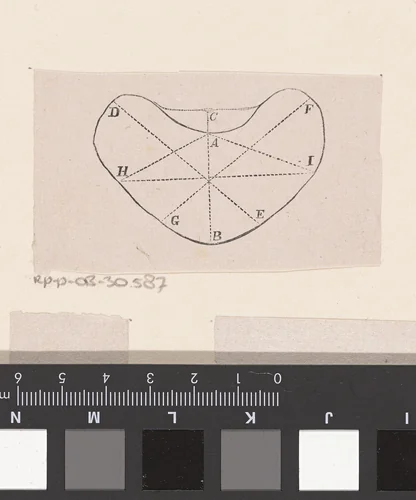 Onderdeel van het menselijk lichaam met een afwijking by Isaac Weissenbruch, print, 1836-1912